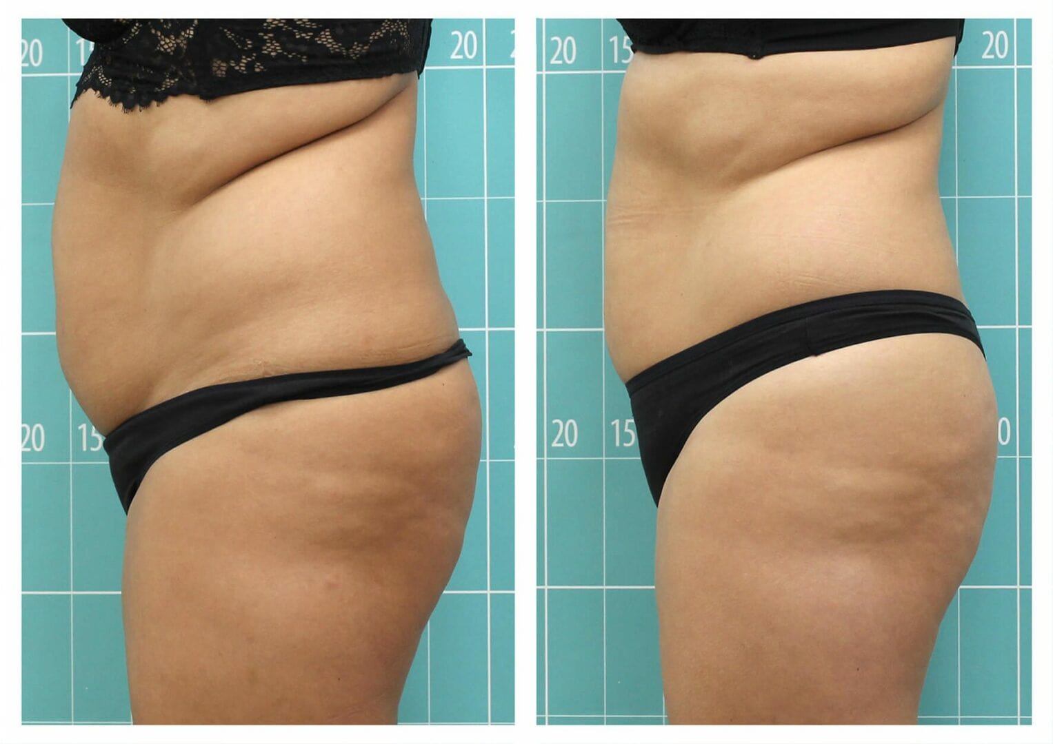Tratamento da gordura abdominal | 3 sessões