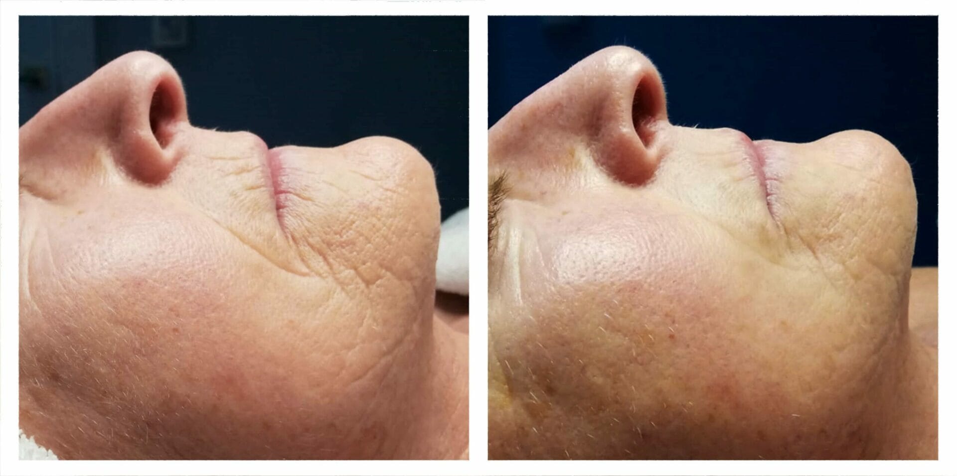facial 2